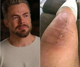 “I’m Fighting — But Not Alone”: Derek Hough Shares Emotional Post-Surgery Message That Moves Fans Worldwide