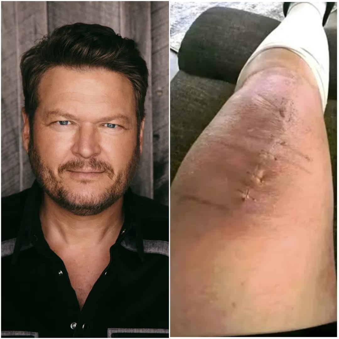 🙏 GOOD NEWS from Blake Shelton: A Heartfelt Message After Surgery Signals Strength, Gratitude, and the Power of Support